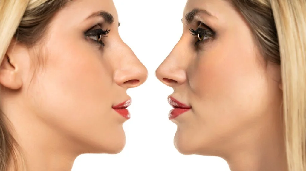 آثار جانبية لعمليات تجميل الشفاه وكيفية الوقاية منها 1 آثار جانبية لعمليات تجميل الشفاه