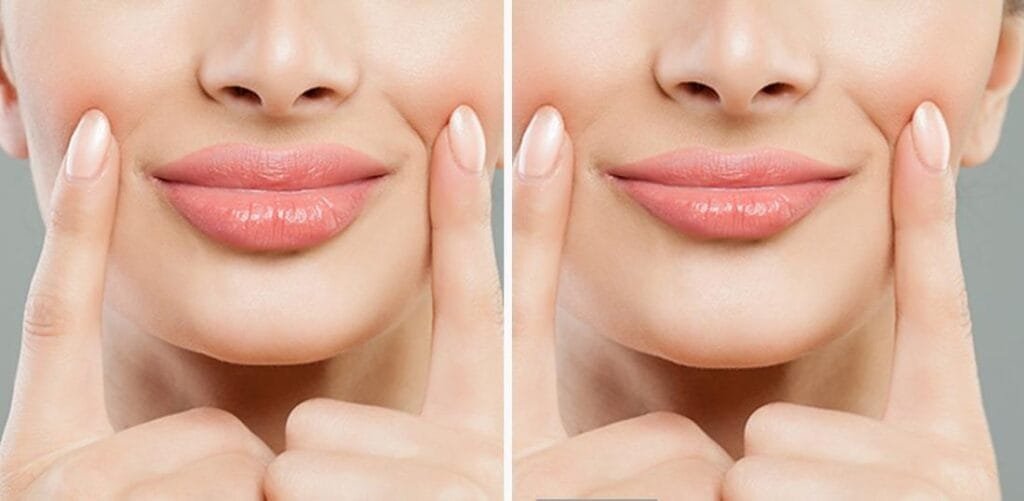 آثار جانبية لعمليات تجميل الشفاه وكيفية الوقاية منها 2 آثار جانبية لعمليات تجميل الشفاه